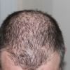 Studie zeigt: Kürbiskernöl GGA hilft gegen genetisch bedingten Haarausfall